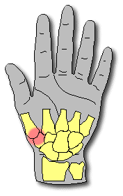 basal joint arthritis
