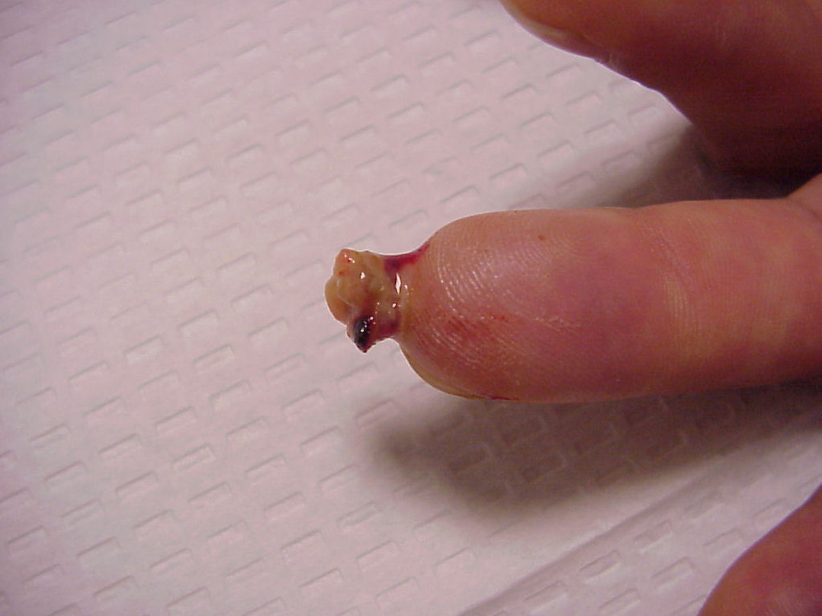 Nail re-growth in fingertip injuries.