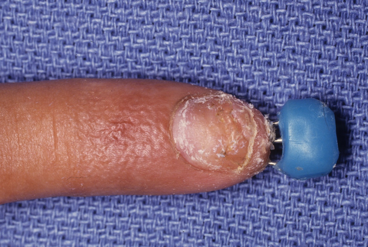 Trauma Percutaneous Pin Stabilization with Thermoplastic Bonding