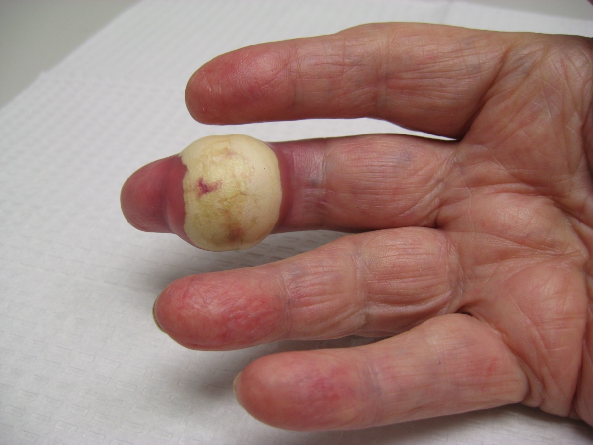 Gout (Gouty Arthritis): Symptoms, Treatment, Causes, & More