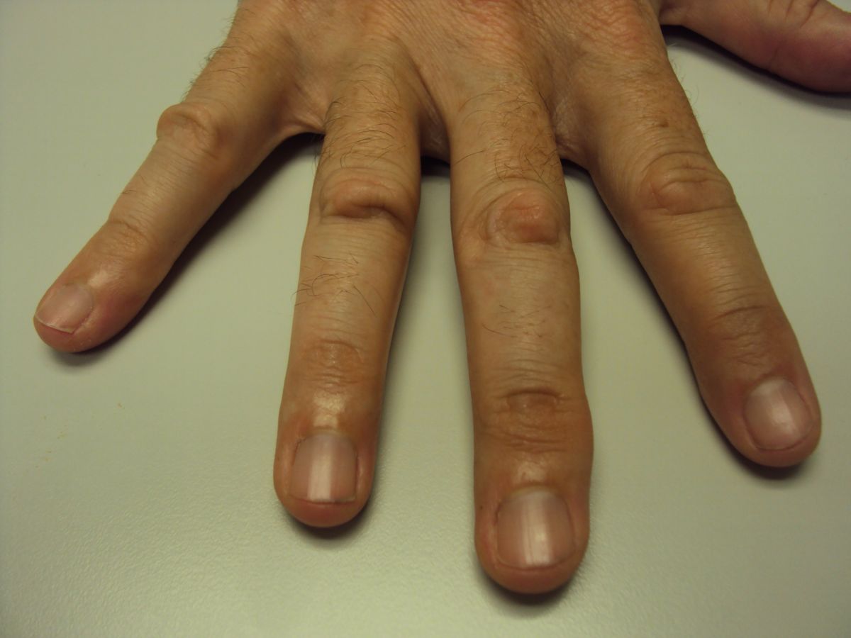 knuckle calluses