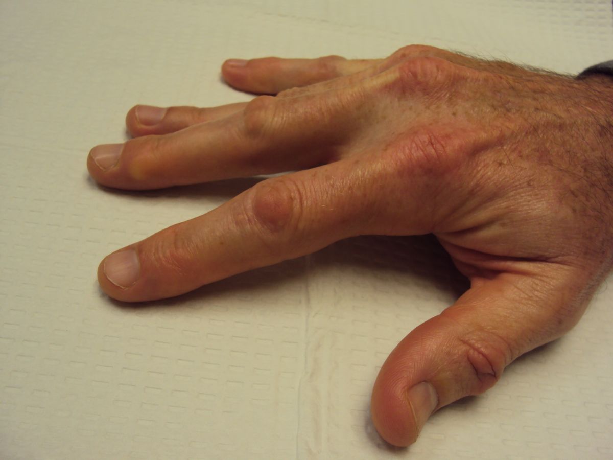 Doctor insights on: White Bump Under Skin On Finger