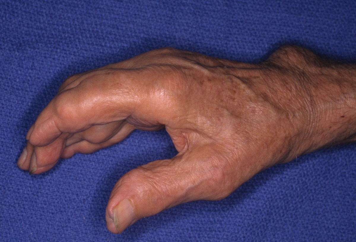 gout hand