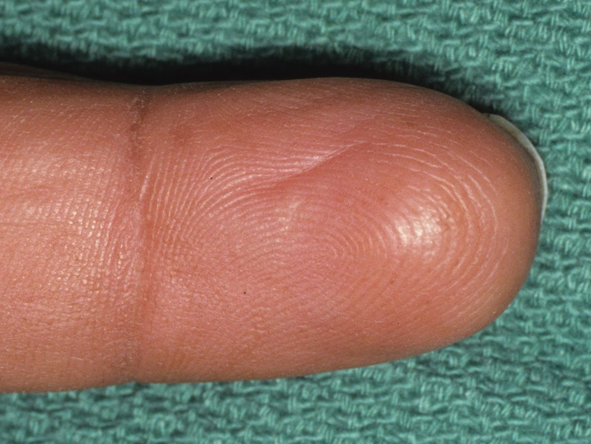 Hand Warts - Conditions to Hand and Fingers - Orthopedic ...