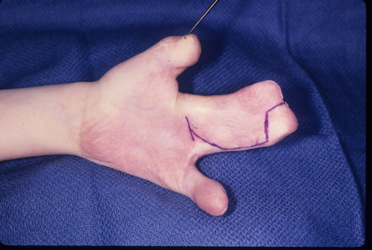 Reconstruction: Free hand harvest thick split thickness skin graft with  primary closure of the donor site for hand coverage