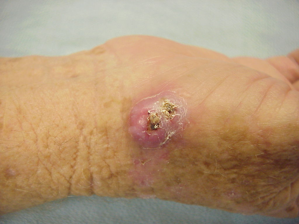Tumor: Keratoacanthoma cases