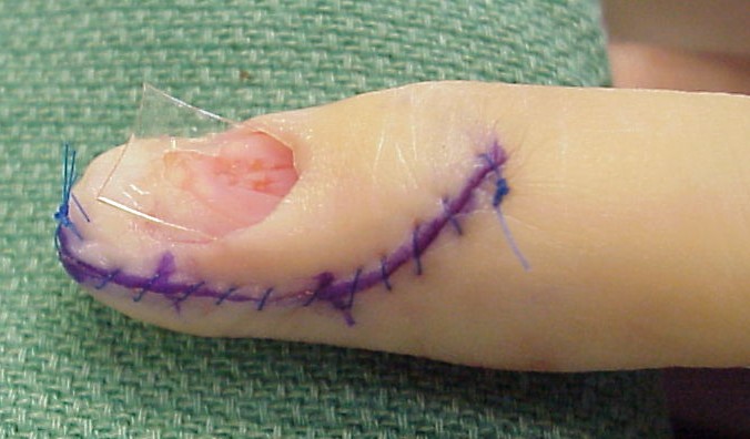 Incision, tumor excision, nail plate removal, wound closure and gelatin