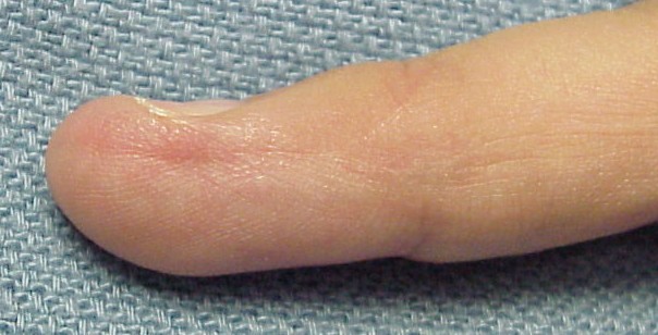 no pain, nail plate not yet fully regrown, but growing normally:
