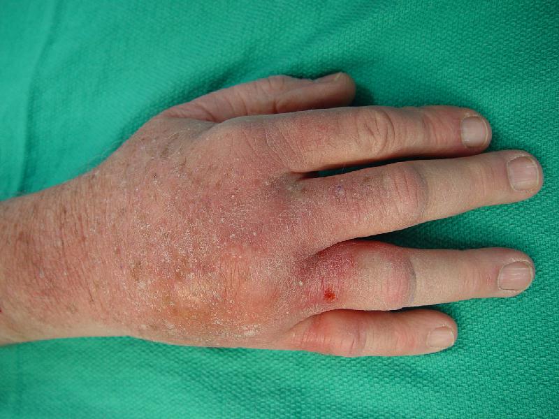 brown recluse spider bite pictures. Probable rown recluse spider