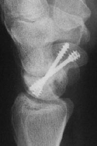 Trauma: Scaphoid fixation with more than one Herbert screw