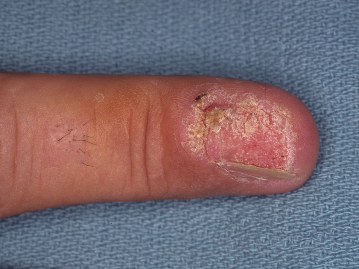Cureus | Methyl Ethyl Ketone-Related Loss of Matrix With Nail Onycholysis  and Pterygium (ME KLMNOP): Case Report of a New Etiology for Onycholysis  and Pterygium | Article