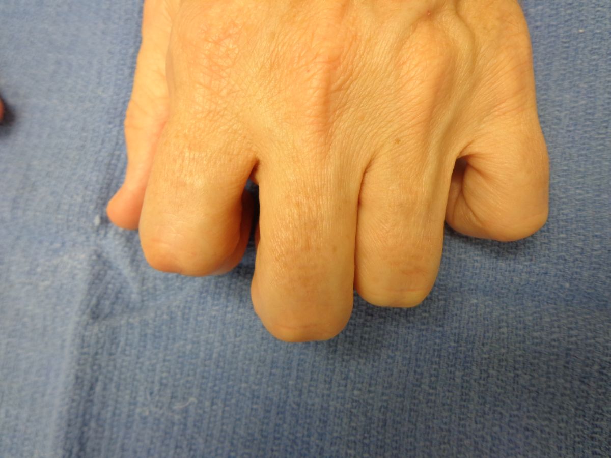 Dupuytren's Knuckle Pads Dorsal Dupuytren Nodules