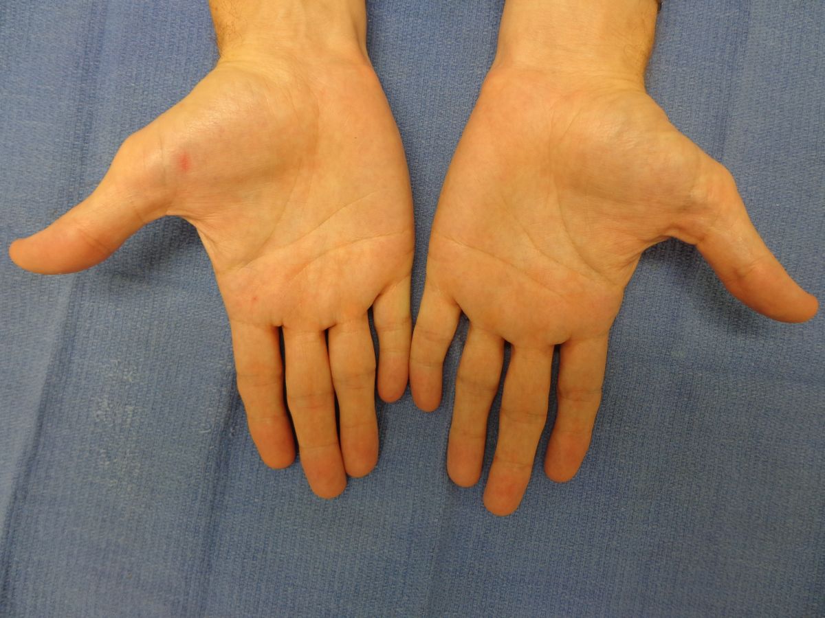 Dupuytren's Knuckle Pads Dorsal Dupuytren Nodules