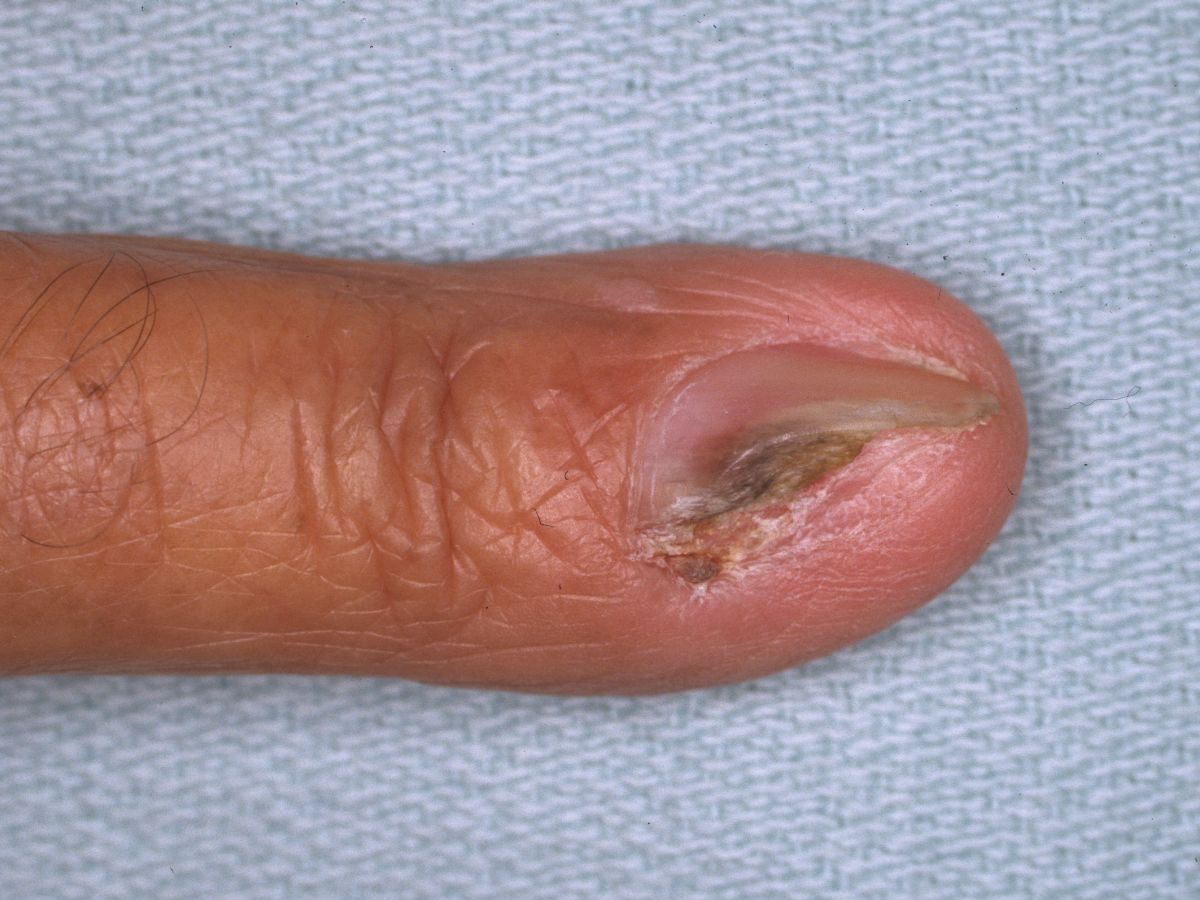 Approach to Fingertip Injuries