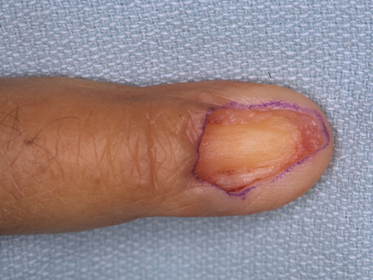 Broken Foot Thumb Finger Nail Old Stock Photo 699025351 | Shutterstock