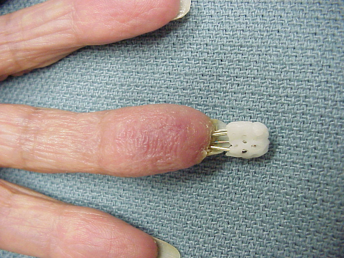 Trauma Percutaneous Pin Stabilization with Thermoplastic Bonding