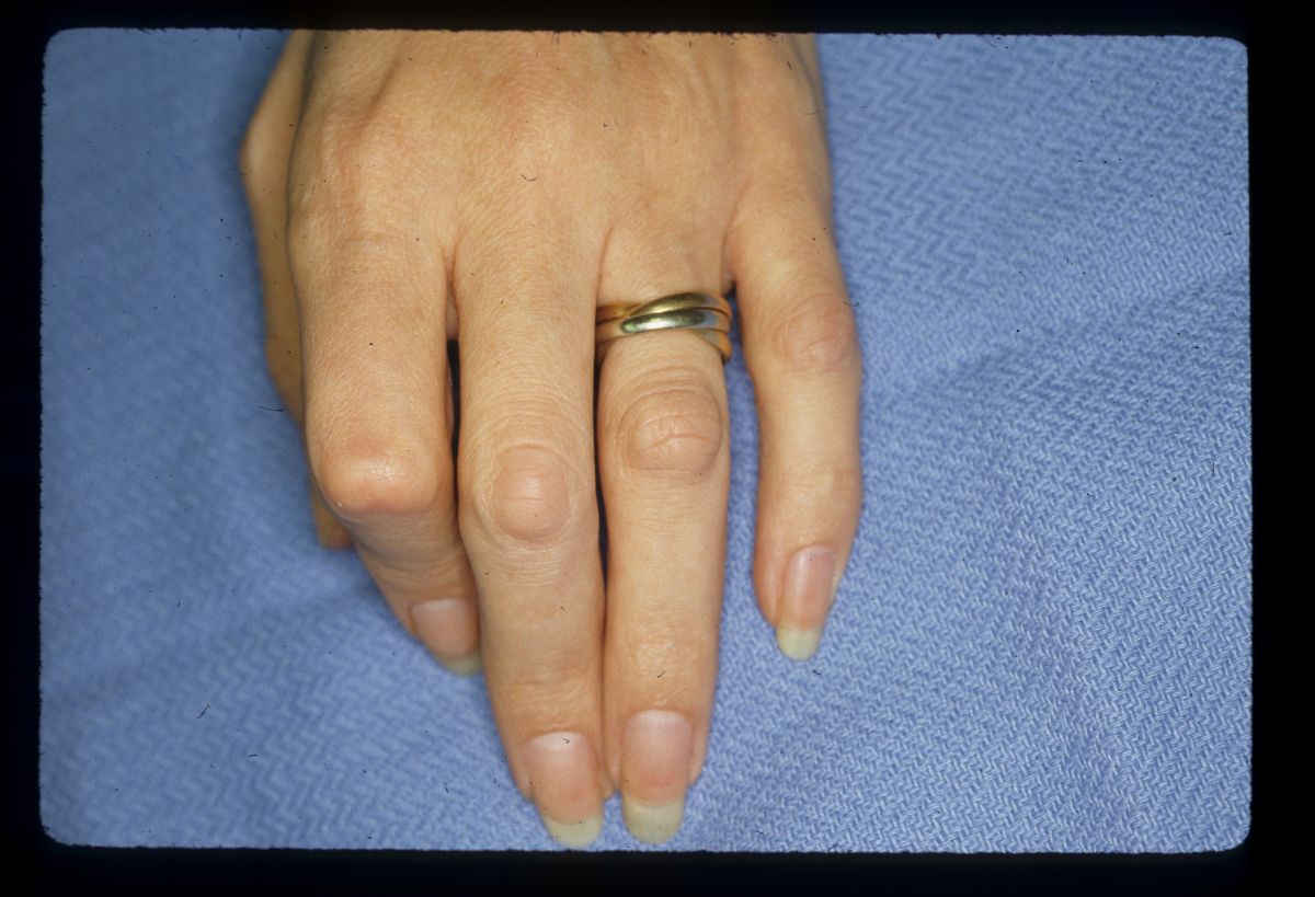 Dupuytren's Knuckle Pads Dorsal Dupuytren Nodules