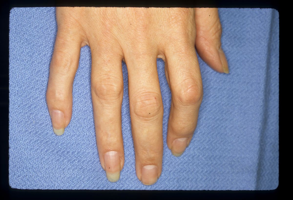 Dupuytren's Knuckle Pads Dorsal Dupuytren Nodules