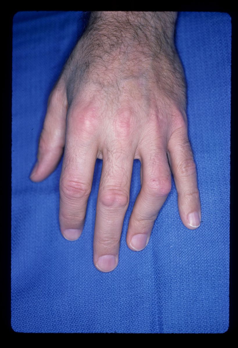Dupuytren's Knuckle Pads Dorsal Dupuytren Nodules