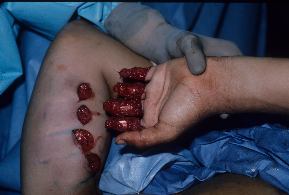 Trauma: Multiple finger degloving treated with medial