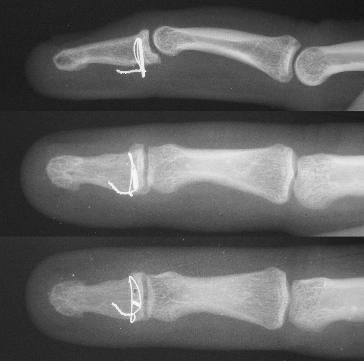 Trauma: Open Reduction Distal Phalanx Base Fractures with Wires and Pins