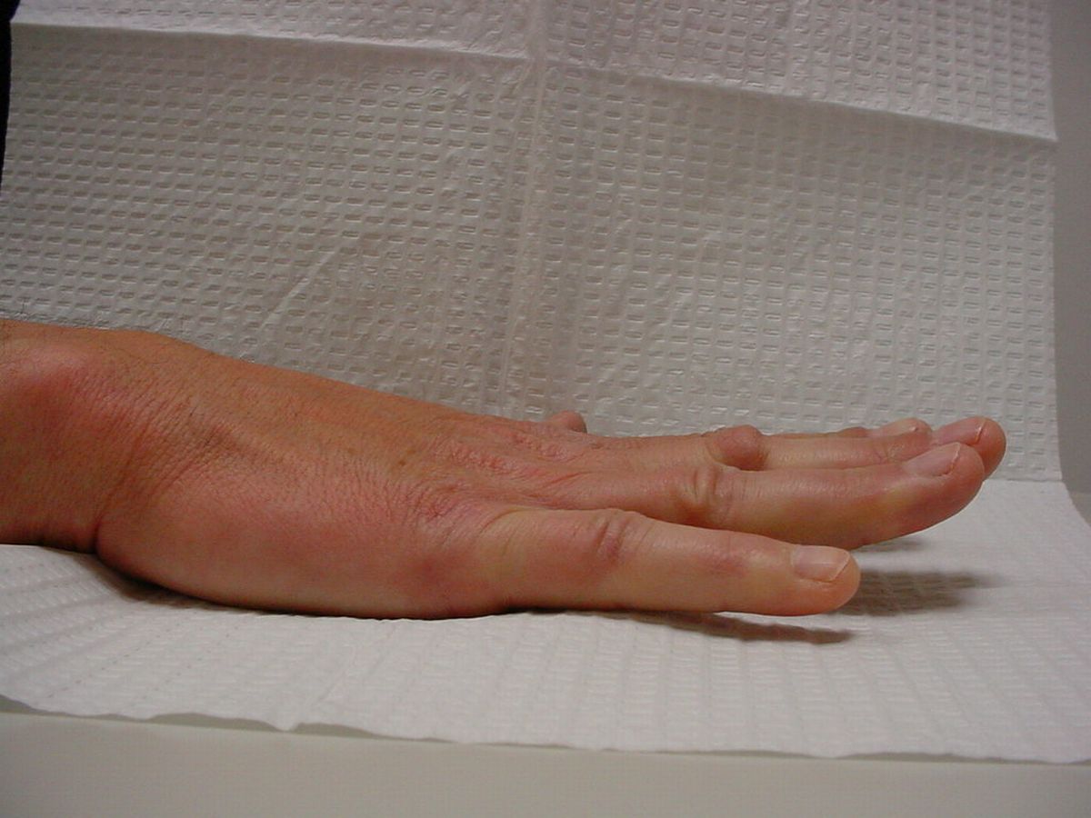 Dupuytren's Knuckle Pads Dorsal Dupuytren Nodules