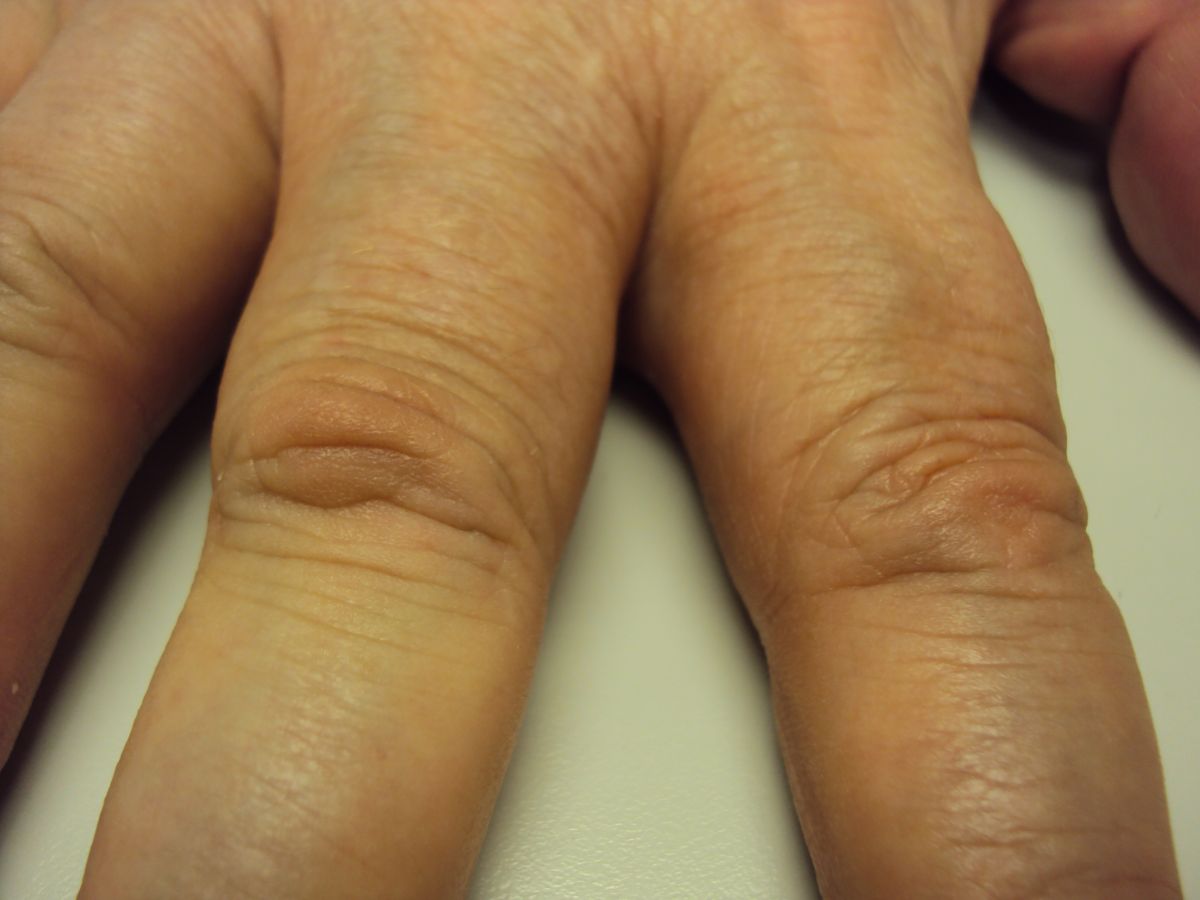 Dupuytren's Knuckle Pads Dorsal Dupuytren Nodules