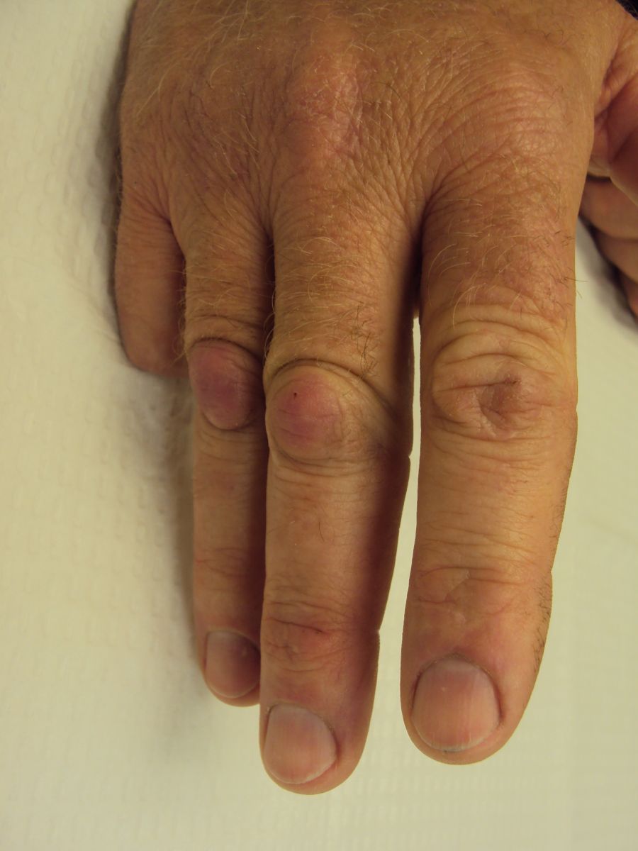 Dupuytren's Knuckle Pads Dorsal Dupuytren Nodules