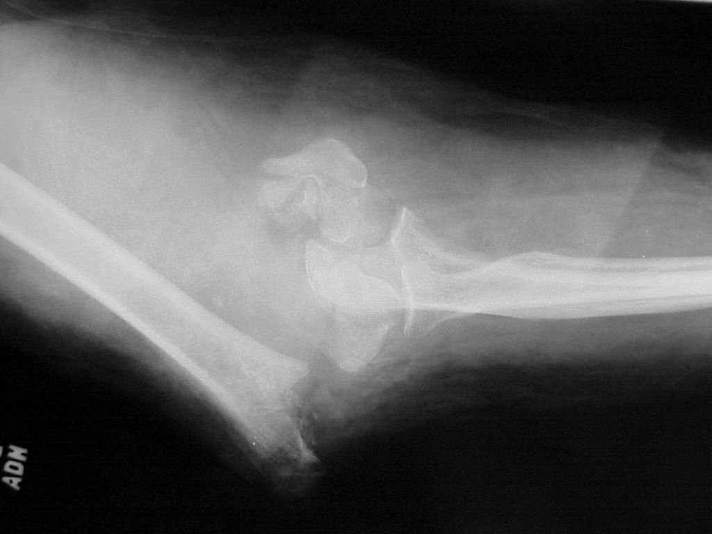 Trauma: Comminuted transcondylar distal humerus fracture
