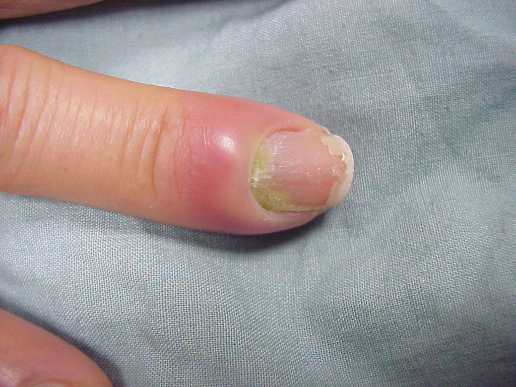 Fingernail of an elderly woman infected with fungal infection. 8060159  Stock Photo at Vecteezy