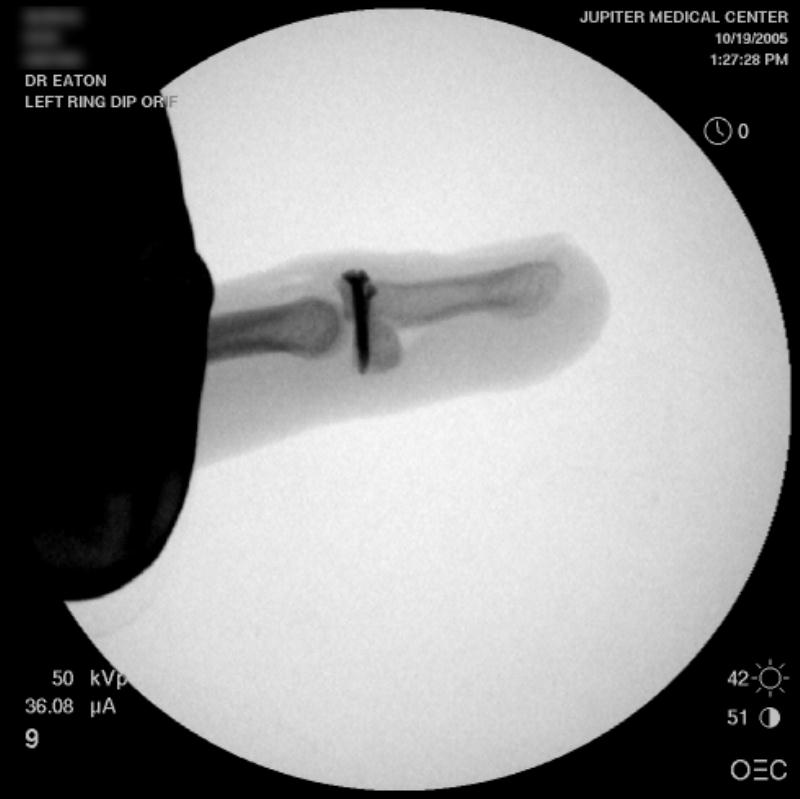 Reconstruction Hamate Hemiarticular Replacement Arthroplasty for