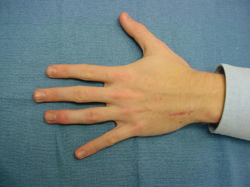 Reconstruction Hamate Hemiarticular Replacement Arthroplasty for Distal Interphalangeal Joint