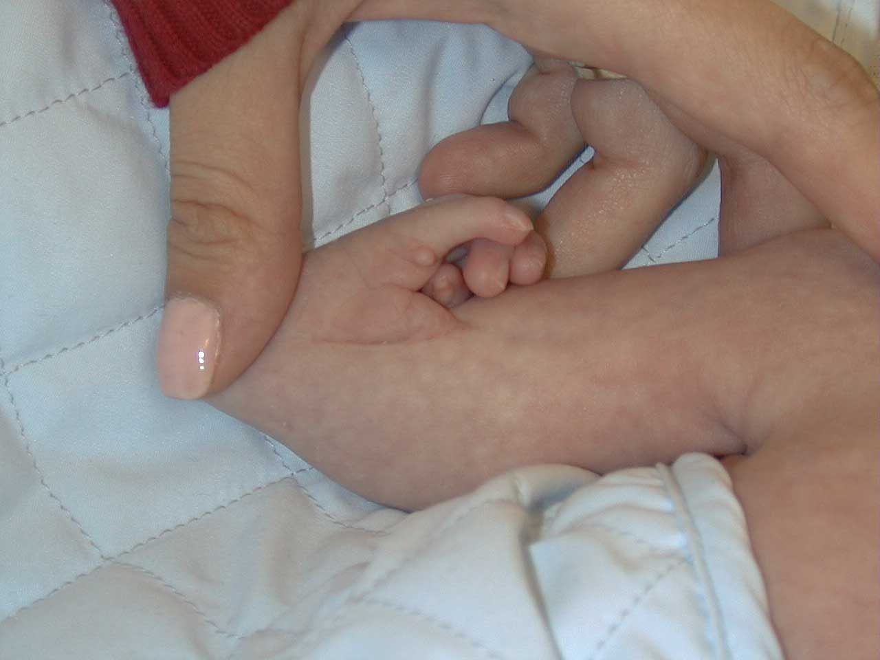 Birth: Radial club hand with complete absence of the radius